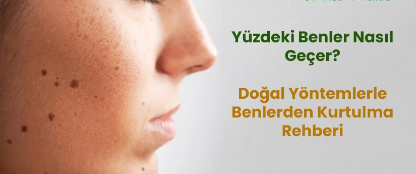 Yüzdeki Benler Nasıl Geçer